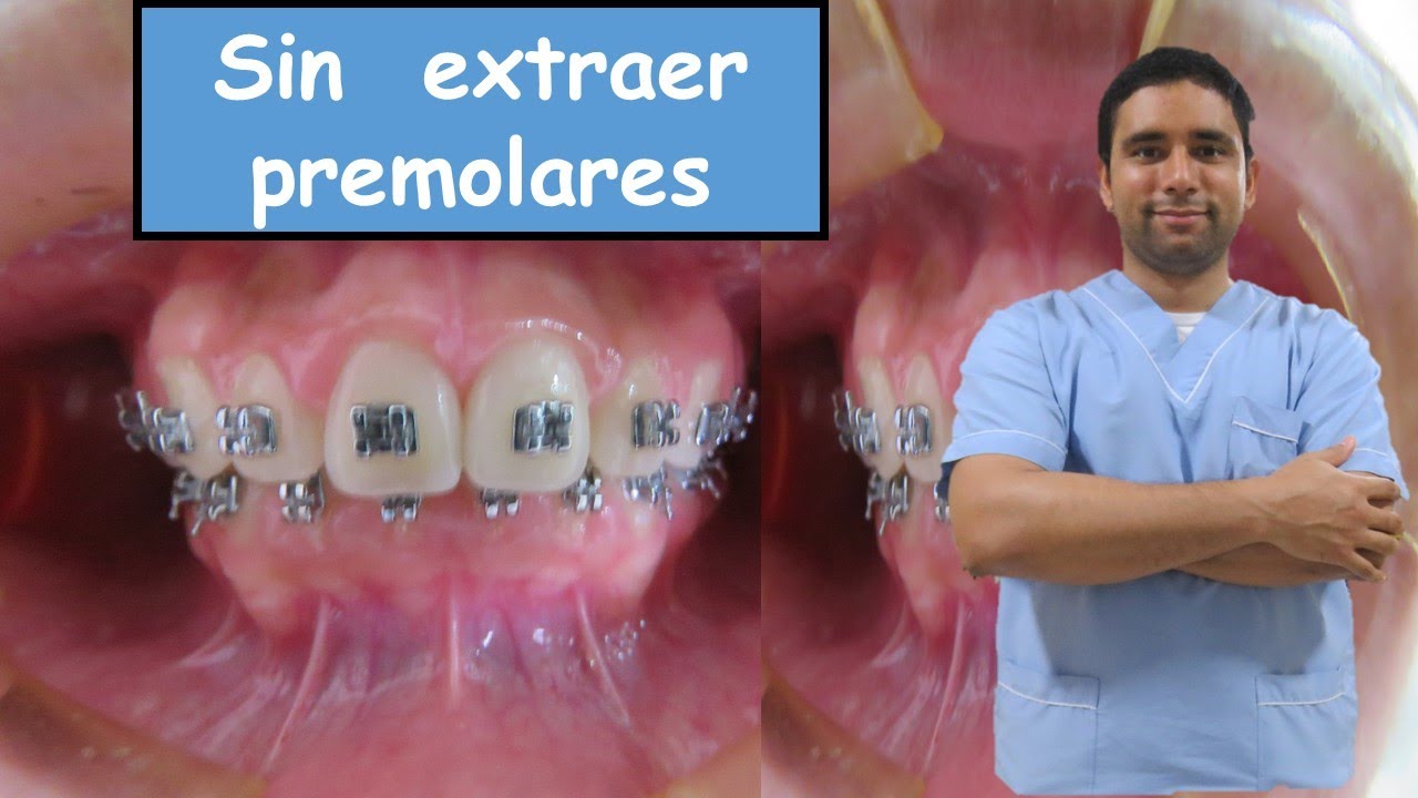 Como se soluciona un Paciente Clase II , 👌sin extraer dientes premolares?