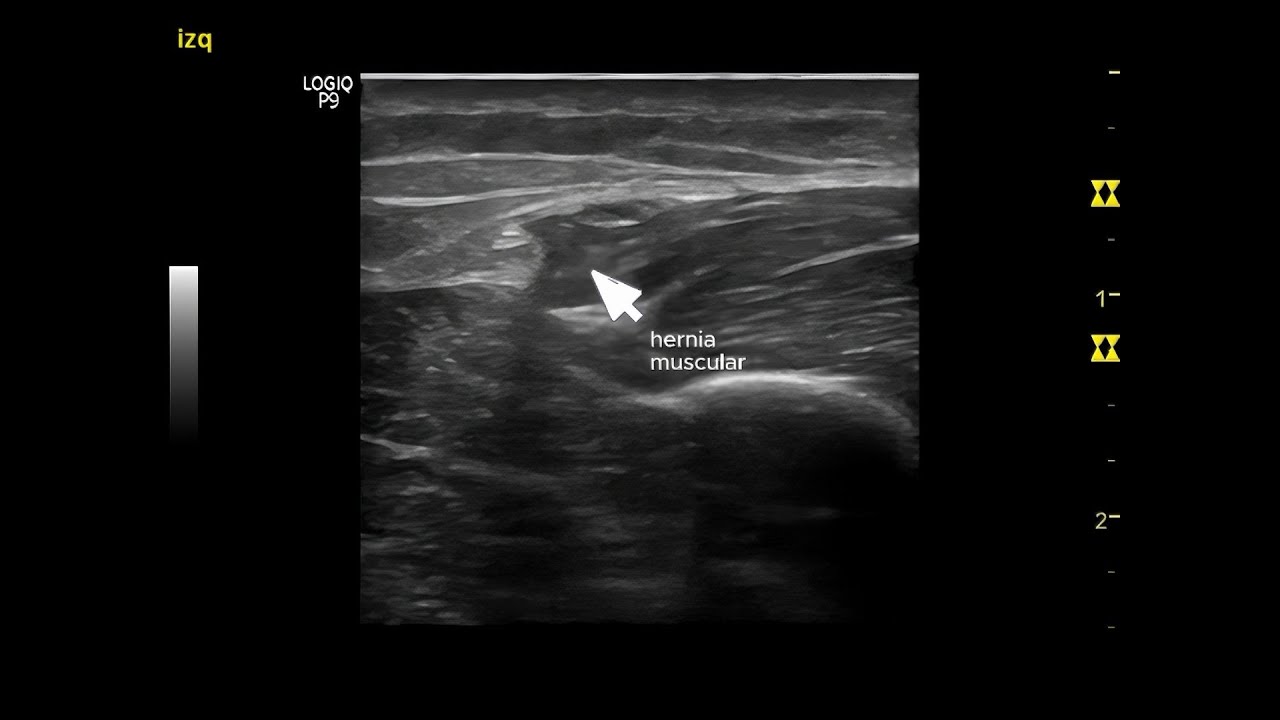 Ecografía de hernia muscular que comprime nervio peroneo superficial