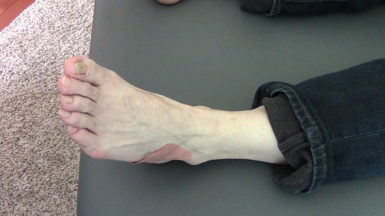 Cuboid Syndrome Treatment Part 1 of 2