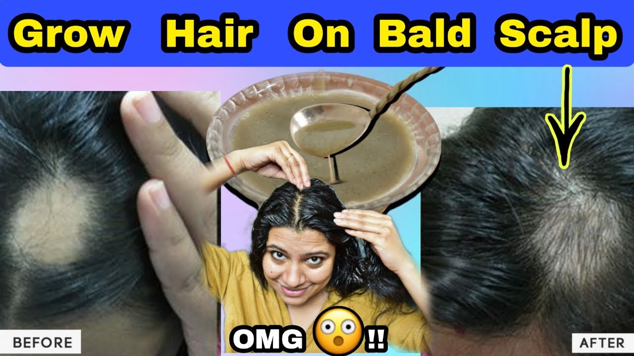 Grow Hair On Bald Scalp Using Remedies Powerful Than Minoxidil गंजे सिर पर बाल उगायें और घना बनायें