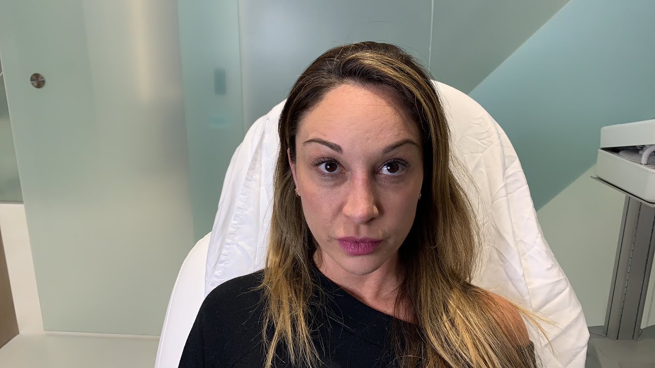 Female Facial Sculpting | Dermal Filler | Cheeks | West Hollywood, CA | Dr. Jason Emer