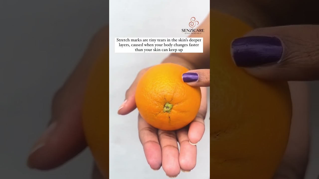 Stretch marks on your breasts?