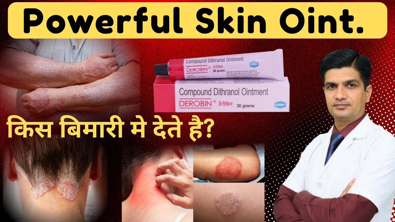 दाद, खुजली, सोराइसिस - सब होंगे ठीक । Derobin ointment uses in hindi