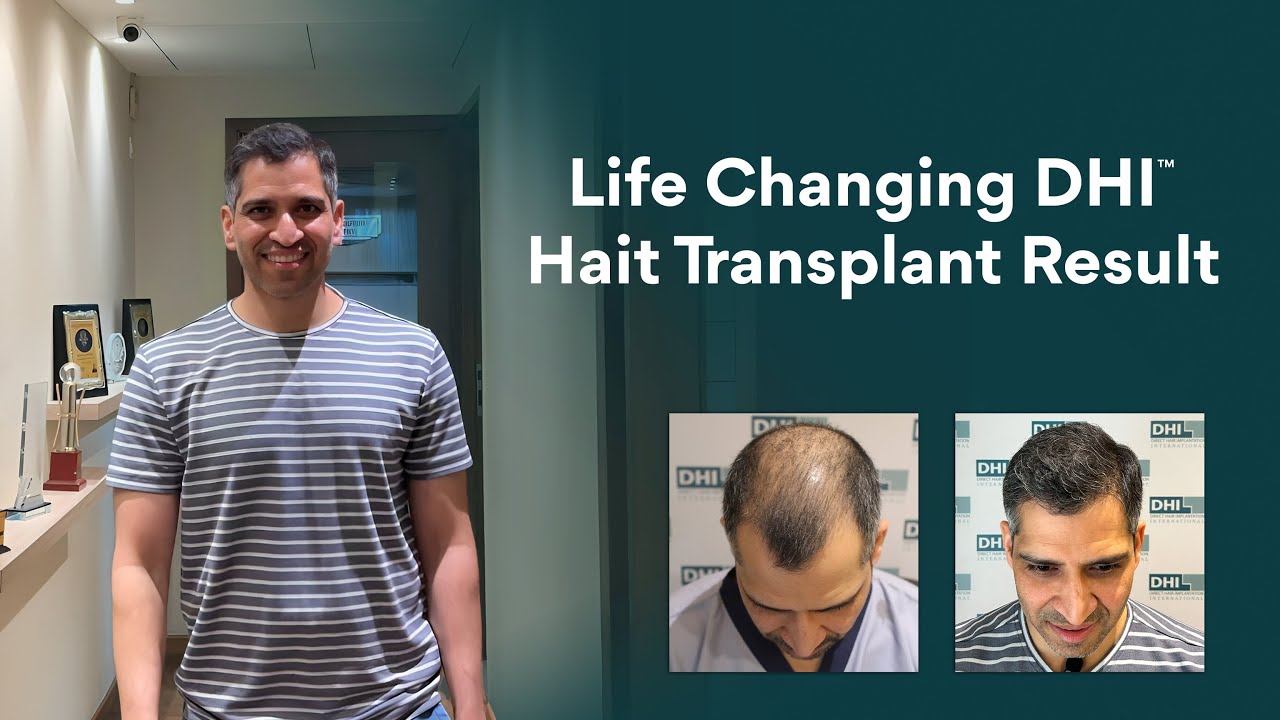 Life-Changing Hair Transplant Journey with DHI™ India: From Hair Loss to Confidence Restored