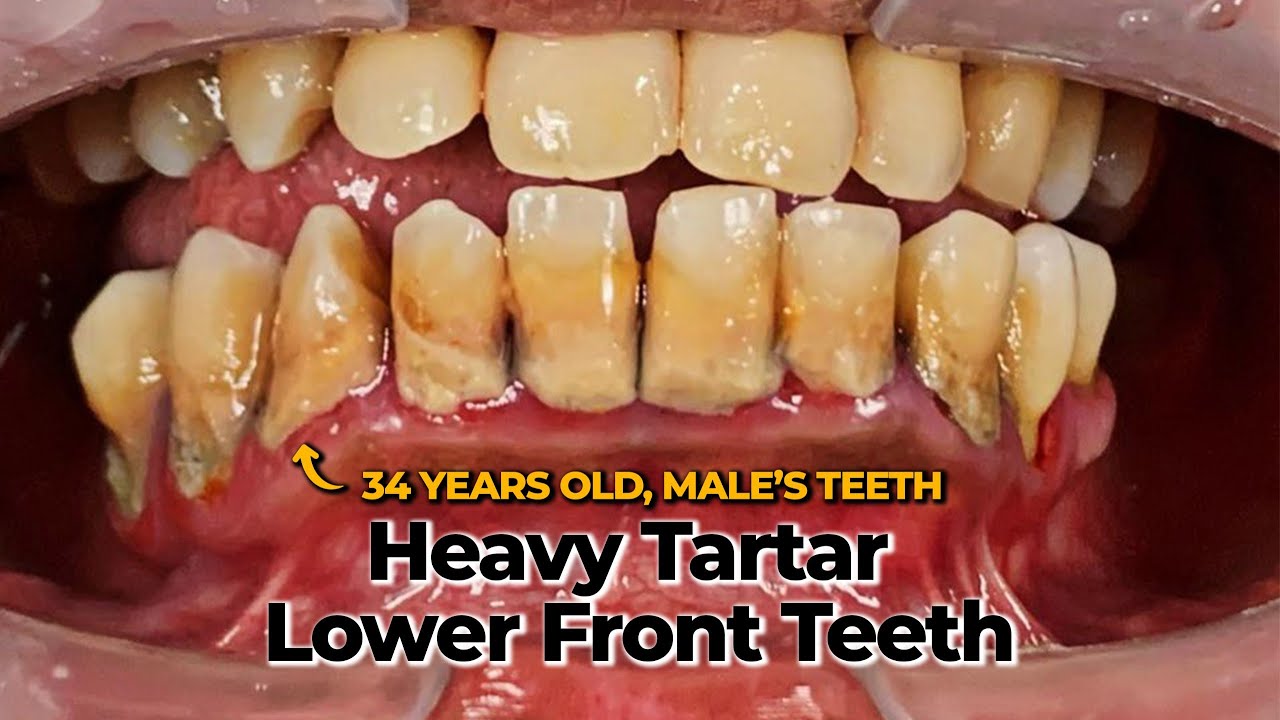 TARTAR | Dokter Gigi Tri Putra