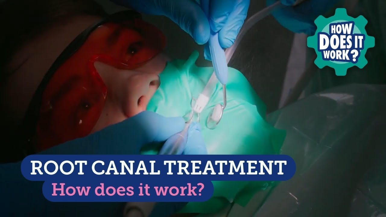 Root Canal Treatment