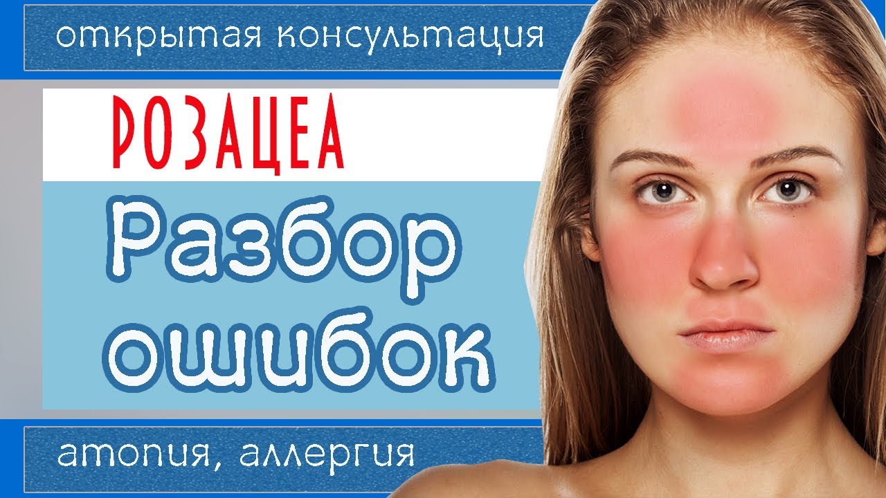 129| РОЗАЦЕА 6. Не повторяйте чужие ошибки (эти мази под запретом)! План действий при ДЕРМАТИТЕ.