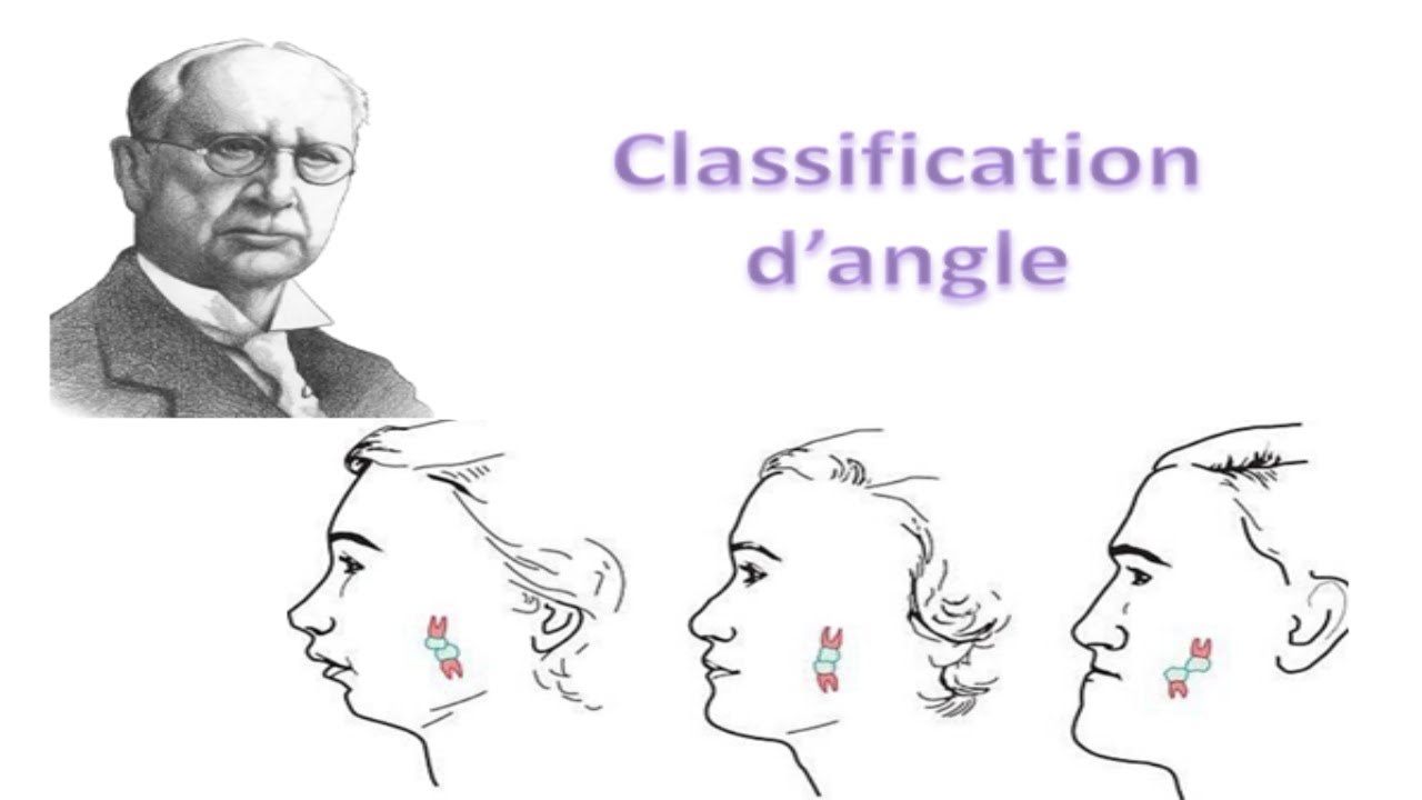 Classification d'angle des malocclusions en Orthodontie