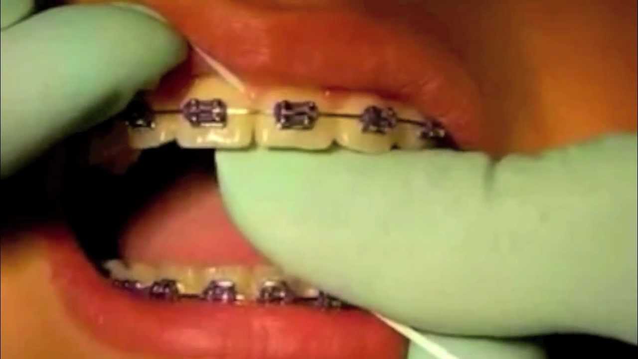 Brushing While Wearing Braces