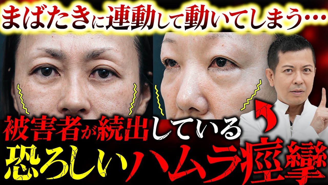 【クマ治療】ハムラ法を受けたことで