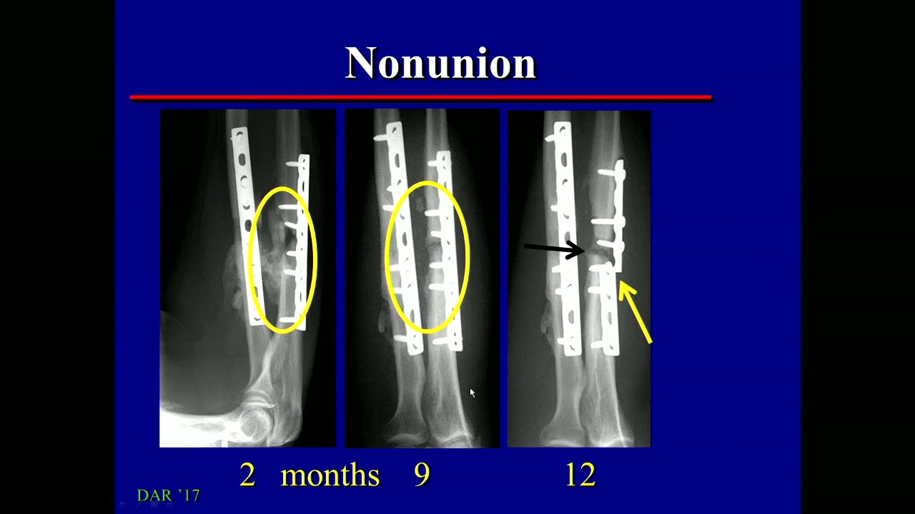 Imaging Abnormal Fracture Healing