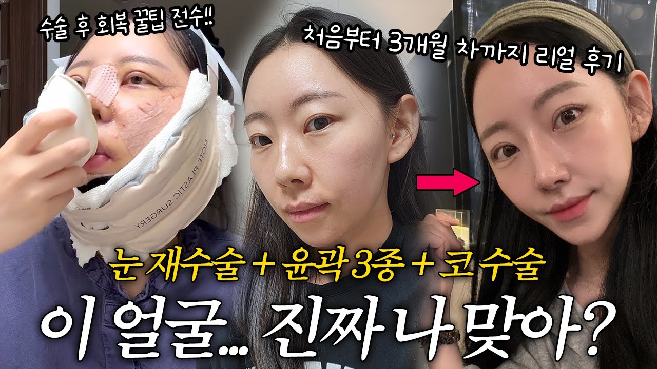 성형 후 3개월 차, 이 얼굴... 진짜 나 맞아? 수술 처음부터 끝까지 리얼 후기 브이로그 [효인Vlog]