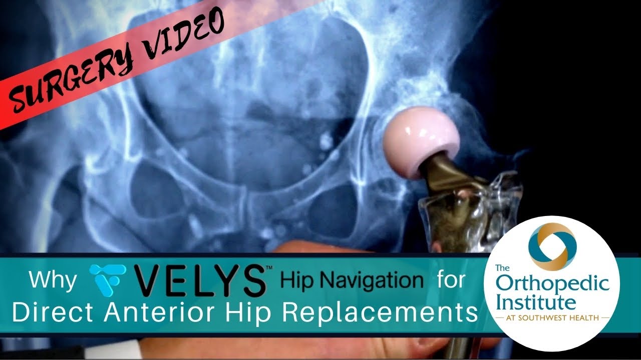 VELYS Hip Navigation and Direct Anterior Hip Replacements