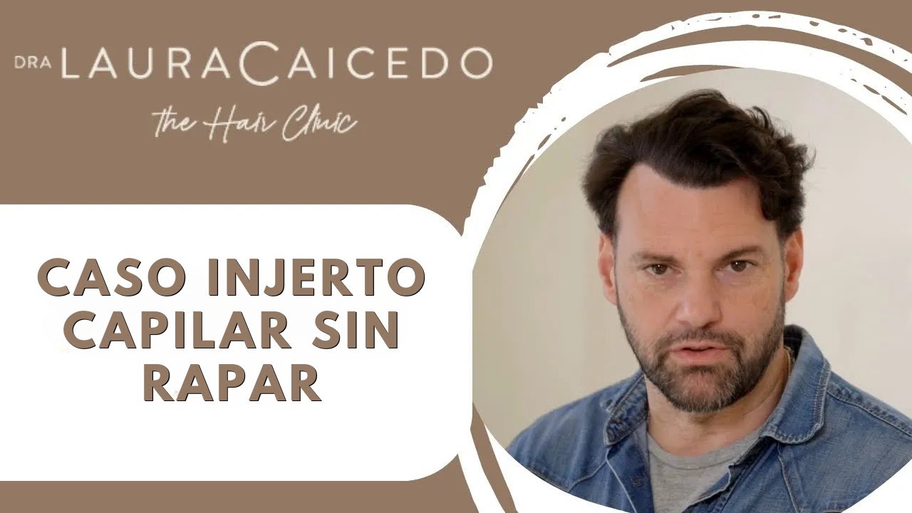 👨🏻 Trasplante Capilar sin rapar- Caso real de Rafa Alarcón