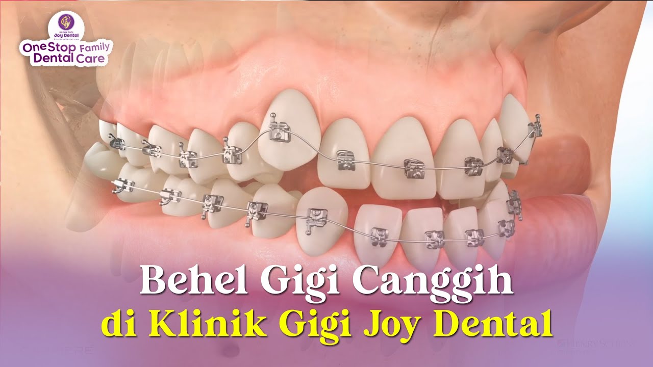 BEHEL PALING CANGGIH DI DUNIA ADA DI JOY DENTAL LO