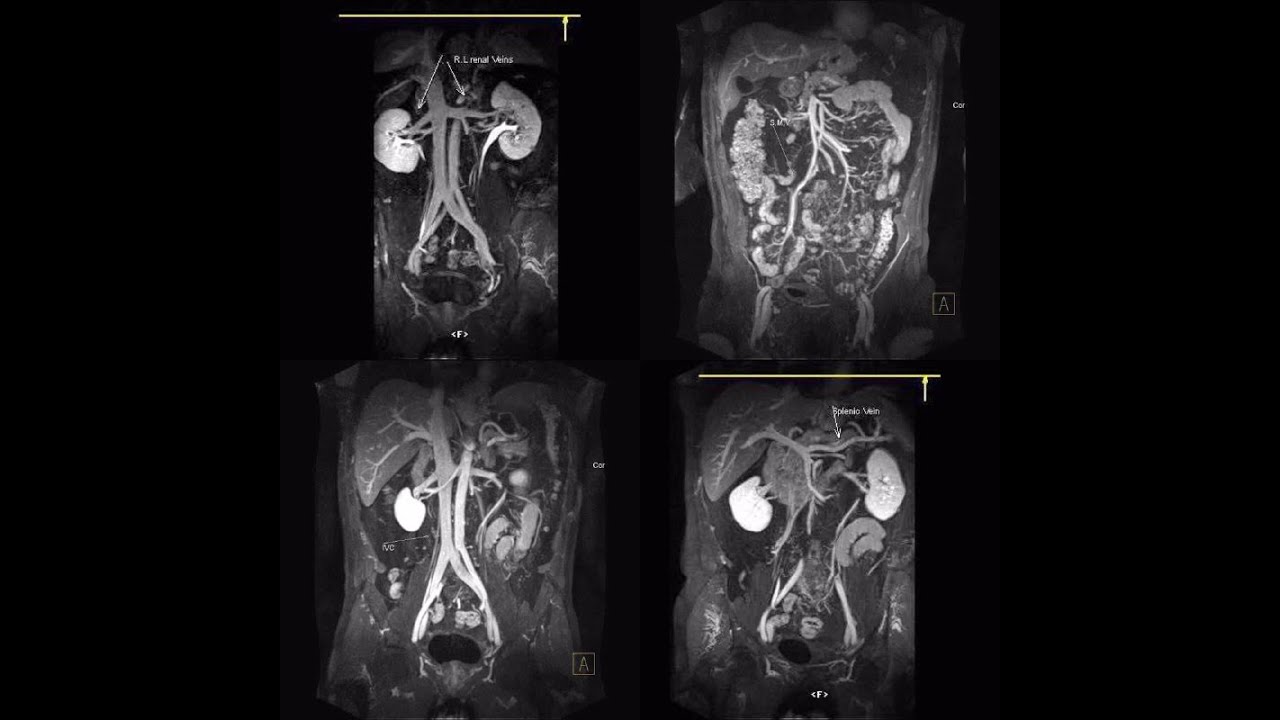MRI Application training ABDOEMN ( MRA and MRV)