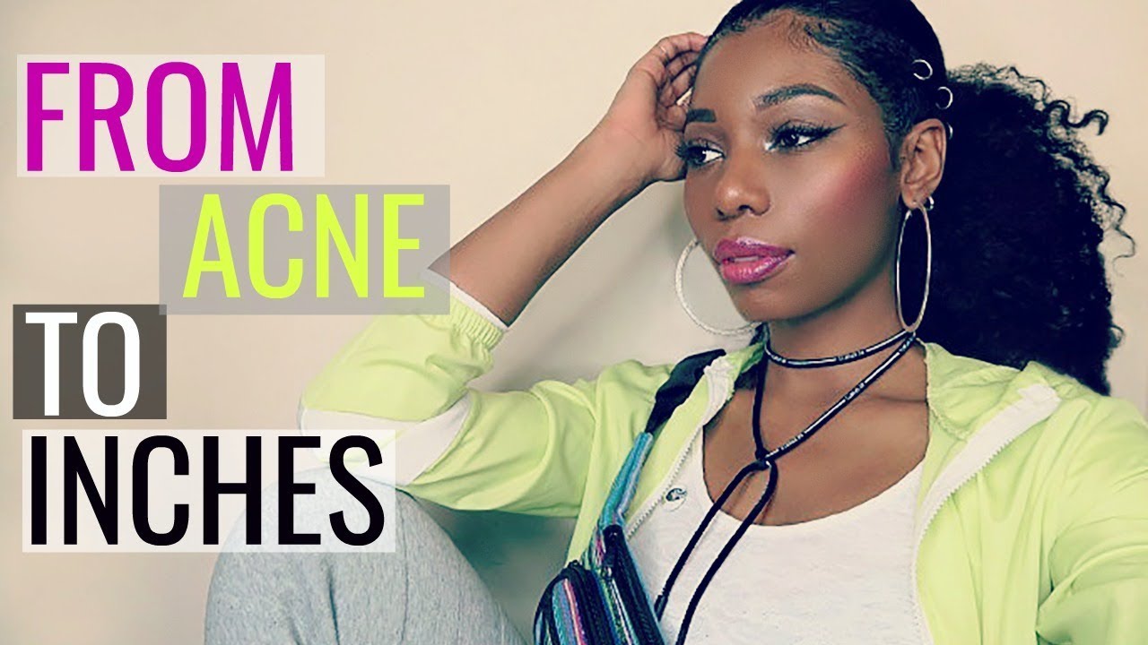 How To Stop Biotin Breakouts