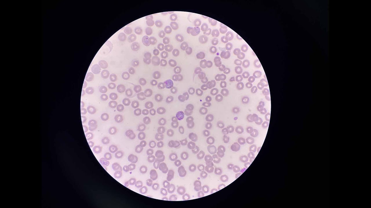 Малярия — эпидемиология, лечение и профилактика | NEJM