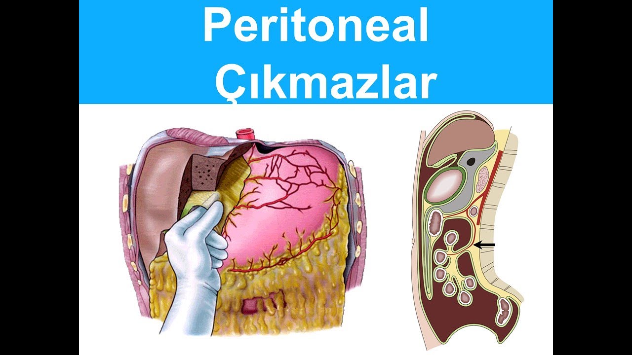 Peritoneal Çıkmazlar YAYDAR