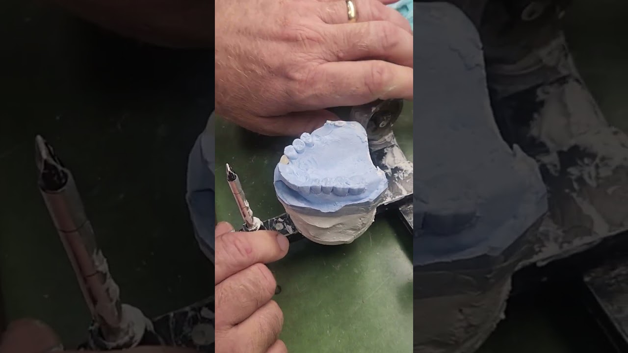 fabricating a maxillary orthotic flipper