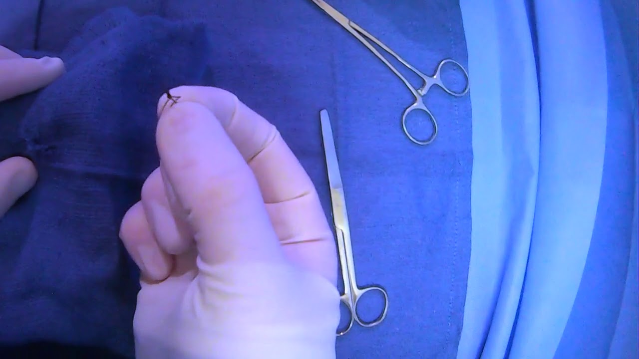 Removing AV Graft/Fistula Access Site Sutures (Removing Toggle Devices)