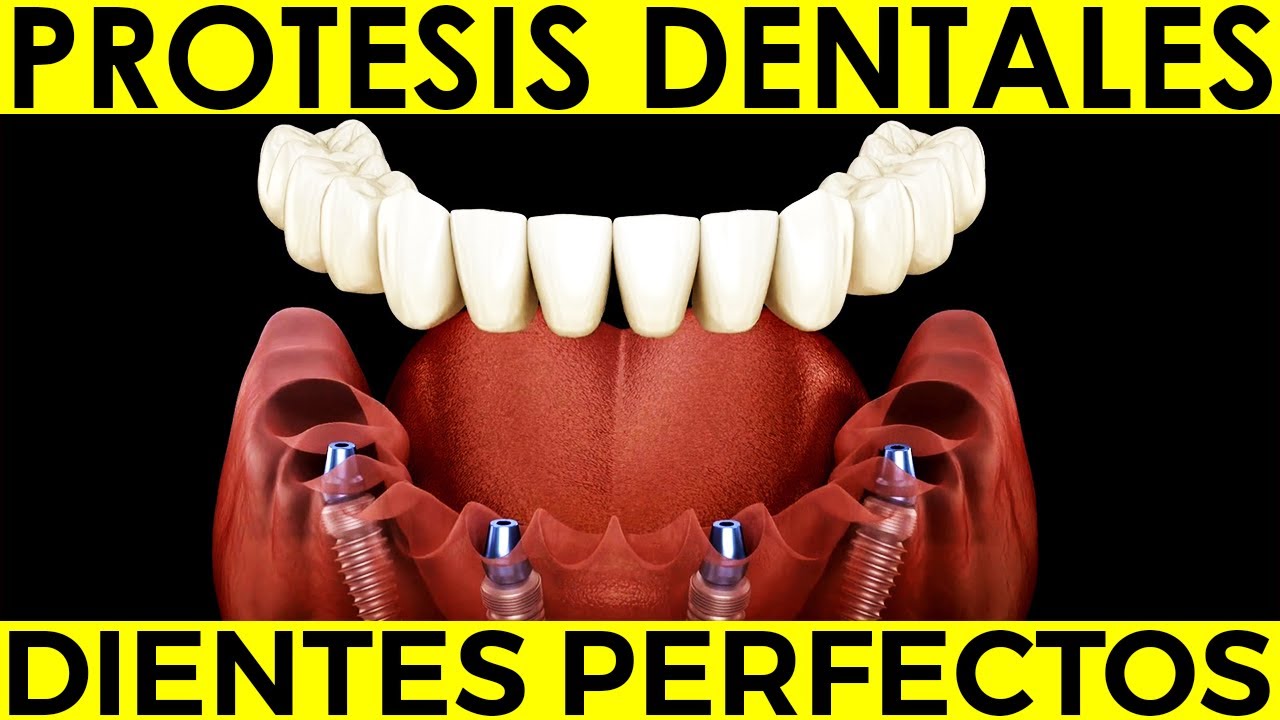 ¿Cómo SABER cuántos IMPLANTES necesito para CORREGIR MIS DIENTES? PROTESIS FIJA EN ARCADA COMPLETA