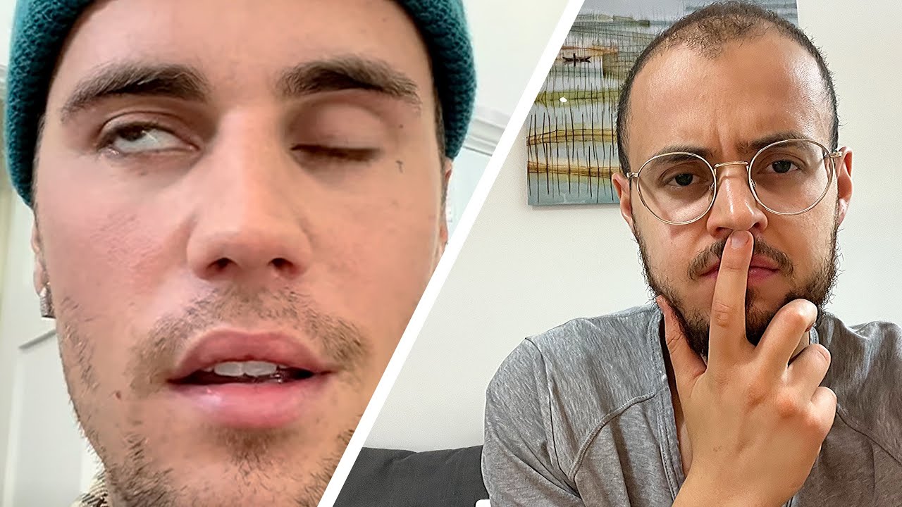 Justin bieber atteint de paralysie faciale ! Reel syndrome de Ramsay Hunt ?