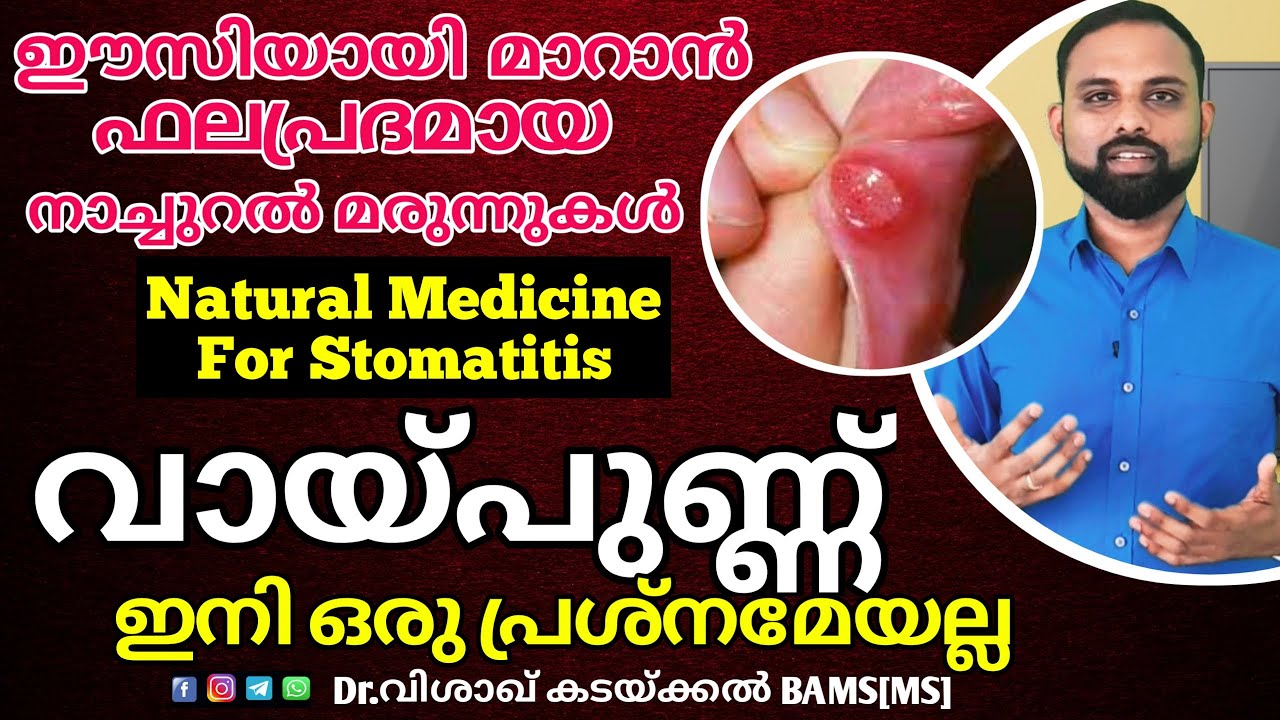 വായ്പുണ്ണ് മാറാൻ 💯 % | Mouth ulcer home remedies malayalam | Stomatitis Home Treatment malayalam |
