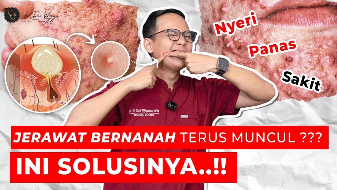 PENYEBAB DAN CARA ATASI JERAWAT BERNANAH - MUDAH BANGETT!! | dr. DWI WIJAYA