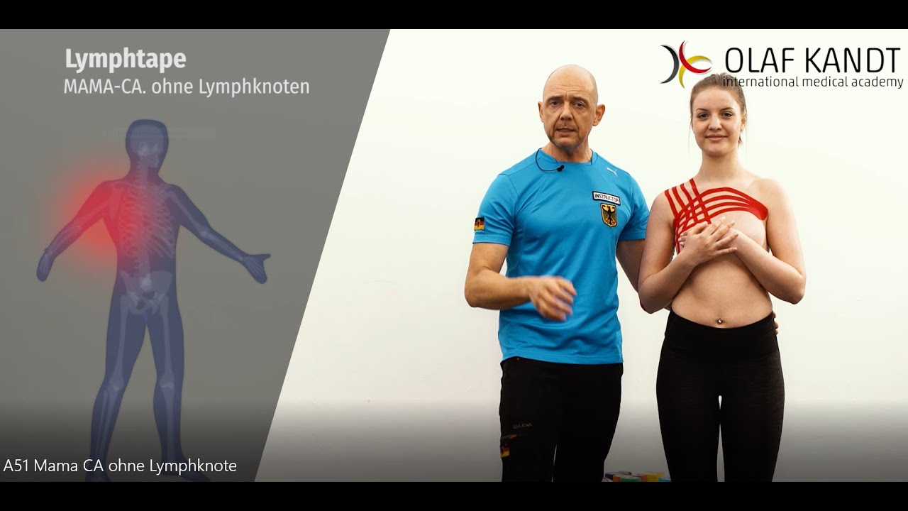 Mamma-ca ohne Lymphknoten