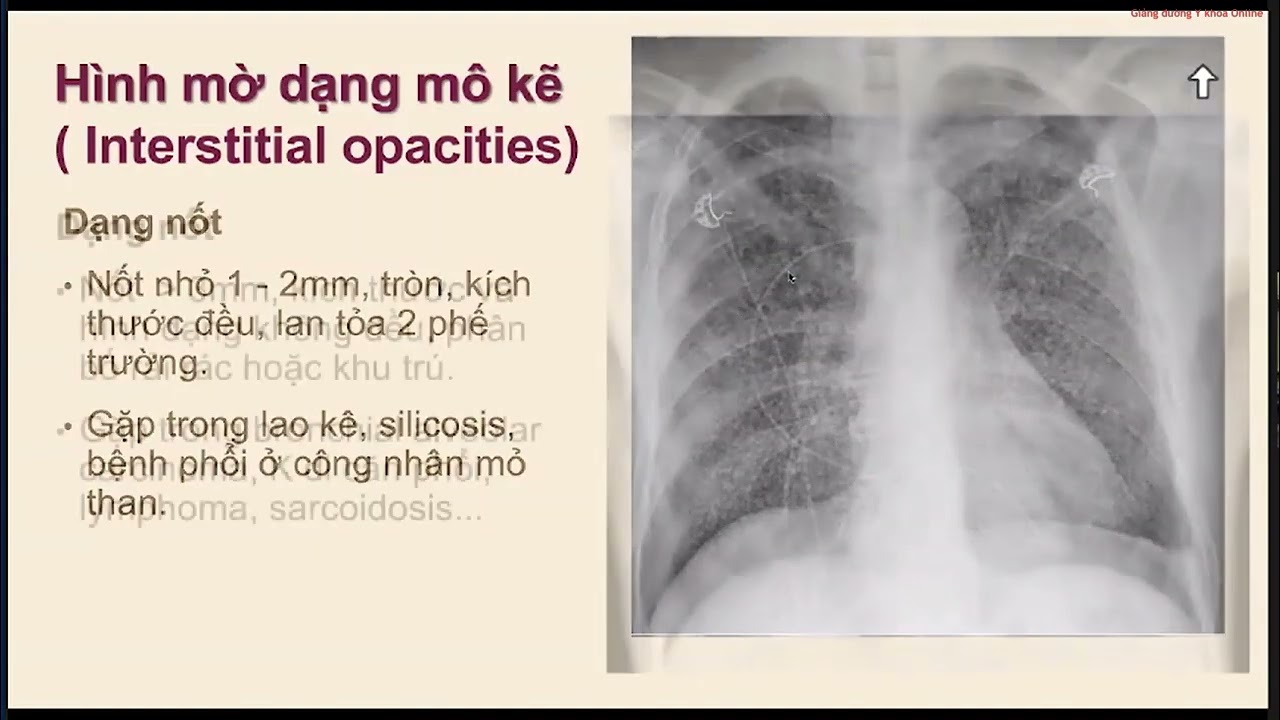 TỔN THƯƠNG MÔ KẼ trên phim X quang và CT scan ngực | TS. BS. ĐỖ THỊ TƯỜNG OANH