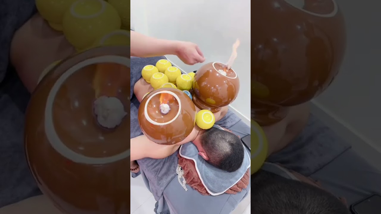 Cupping Therapy with Double Big Cup #asmr #cupping #xuhuong #trilieuhaiphong #massage #Giachoi