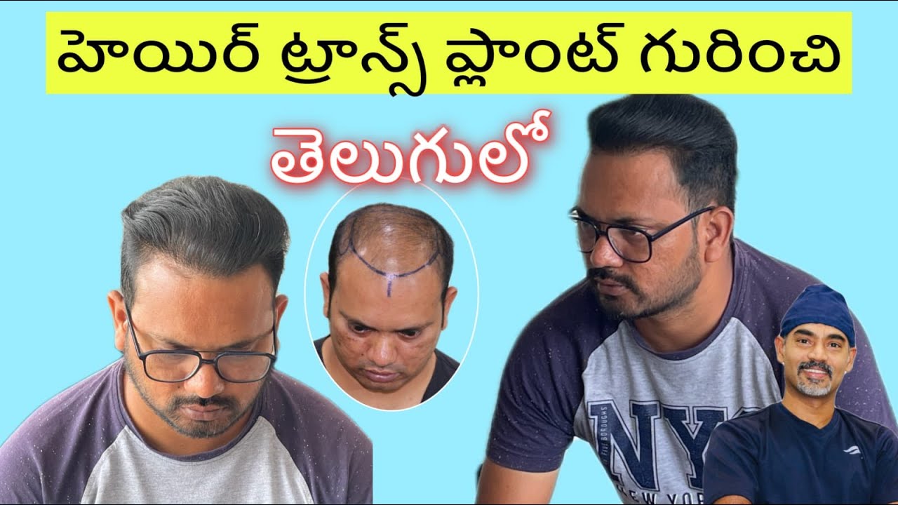 hair transplant visakhapatnam |  Best cost results hair transplant vizag.