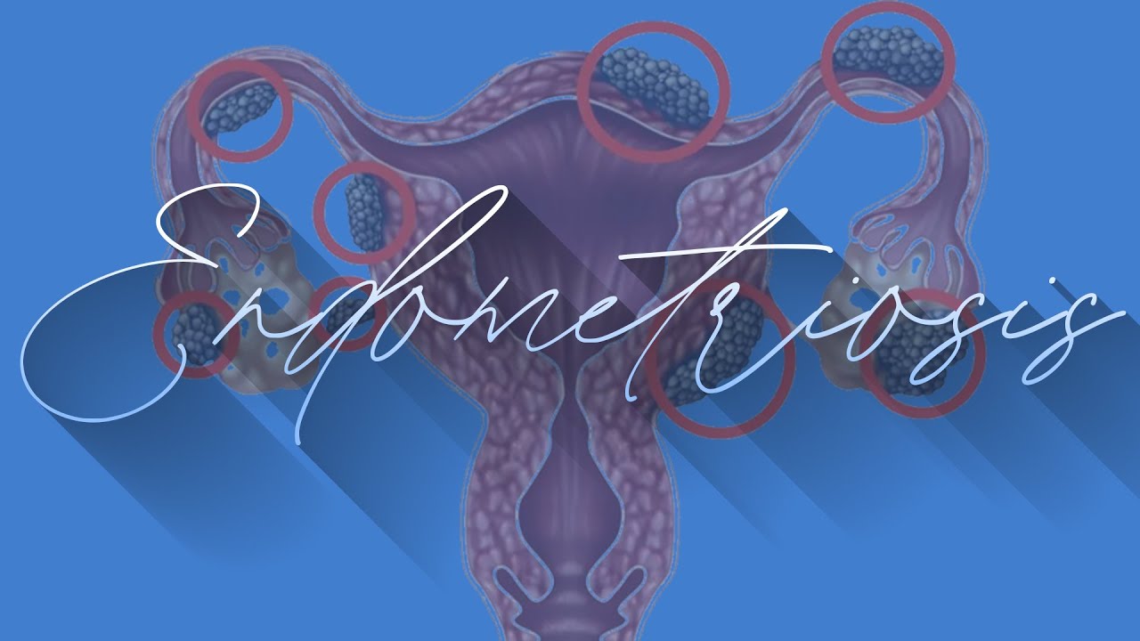 Endometriosis Relief: How To Spot, Diagnose & Manage Symptoms | Apollo Hospitals