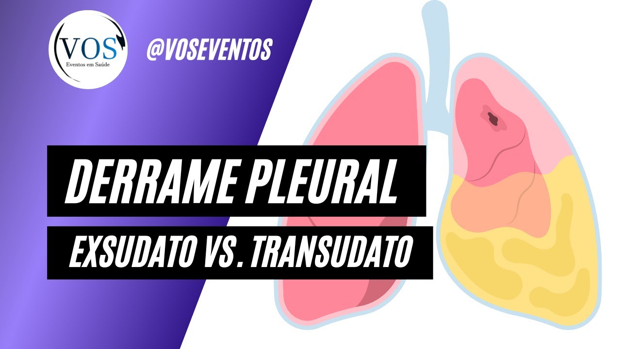 Derrame Pleural | Critérios de Light para diferenciar TRANSUDATO de EXSUDATO.