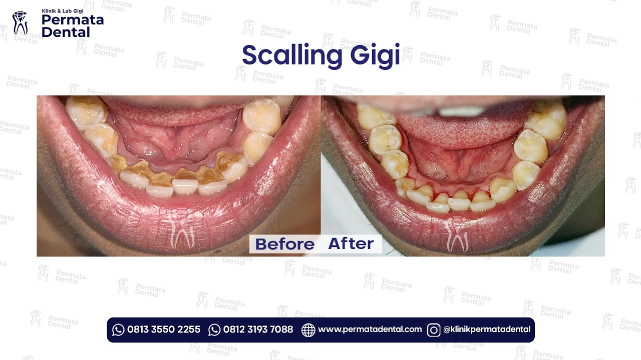 Gigi Jadi Bersih & Sehat! Proses Scalling Gigi di Klinik Permata Dental
