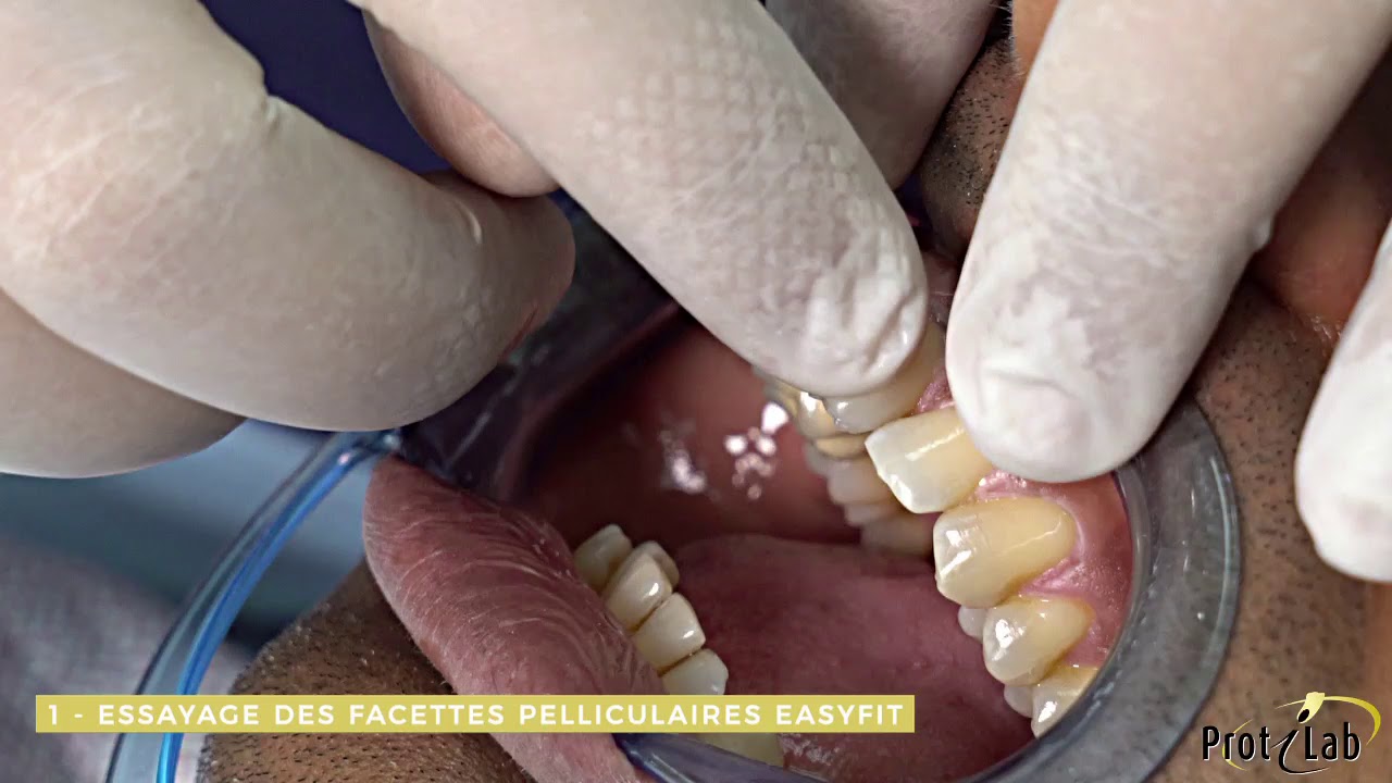 PROTILAB - Tuto : pose des facettes pelliculaires easyfit®