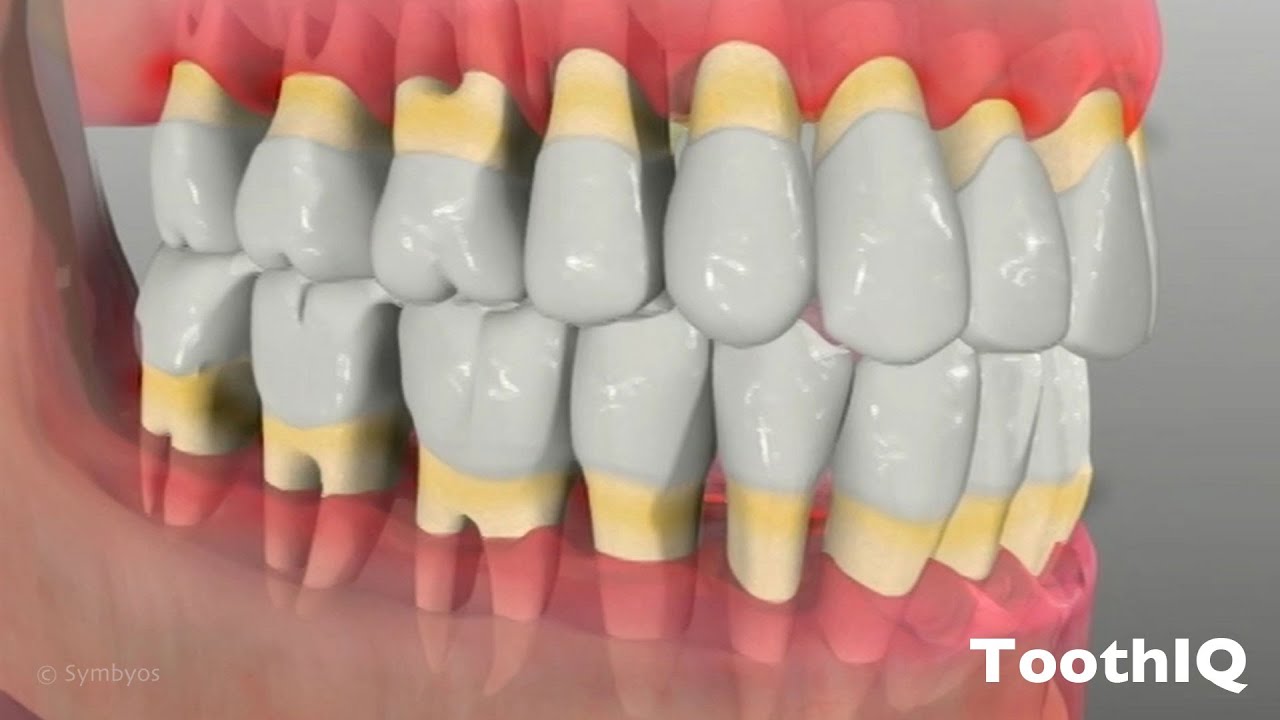 Periodontal Disease
