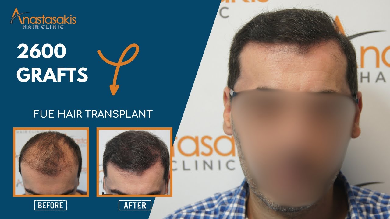 See the result - Case #268 | Hair Transplant: stage 4 to 5, FUE & 2600 grafts | 8,5 months after ! 🌟