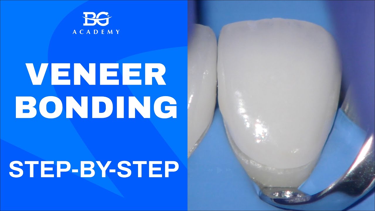 Veneer bonding: step by step