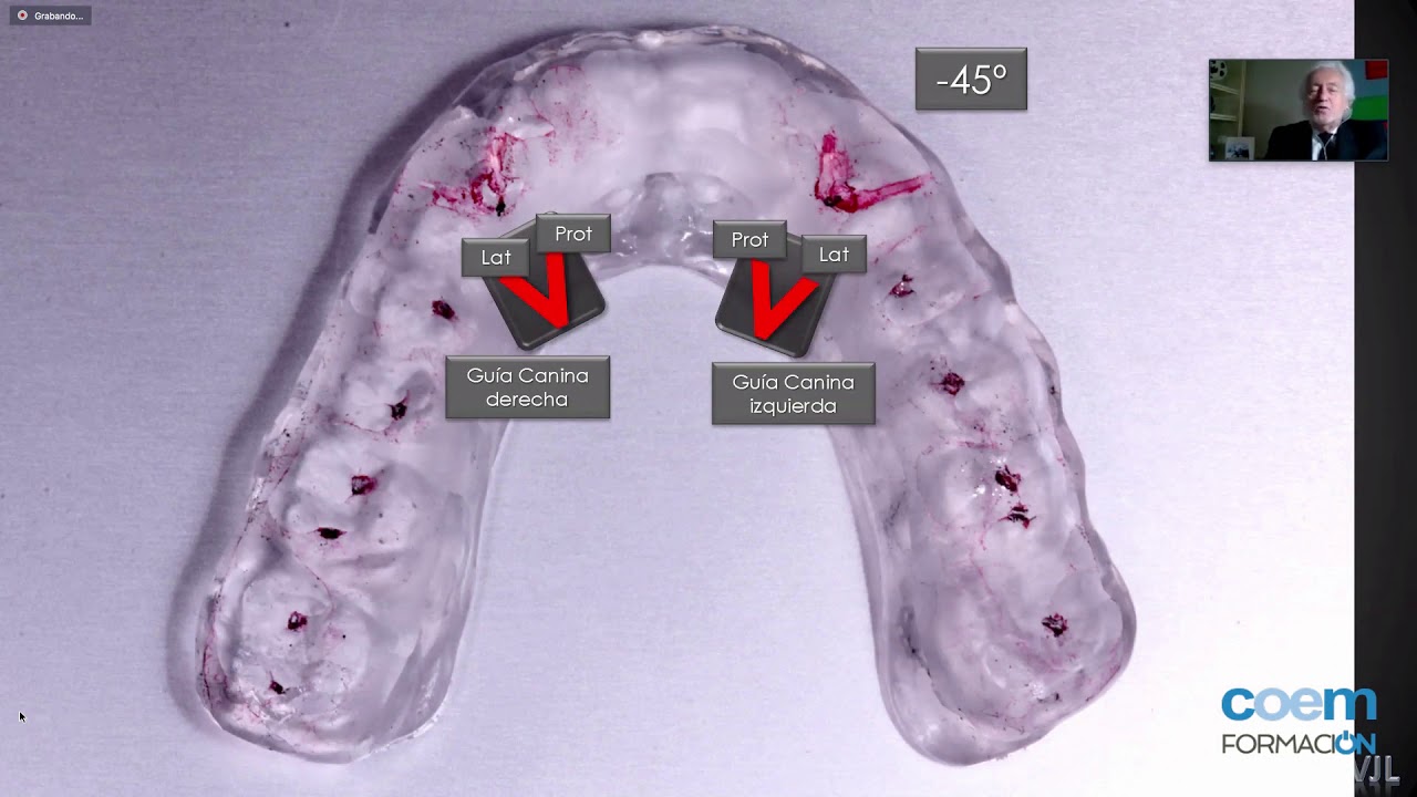 Férulas oclusales: su diseño y ajuste (2ª Parte) | Dr. Vicente Jiménez