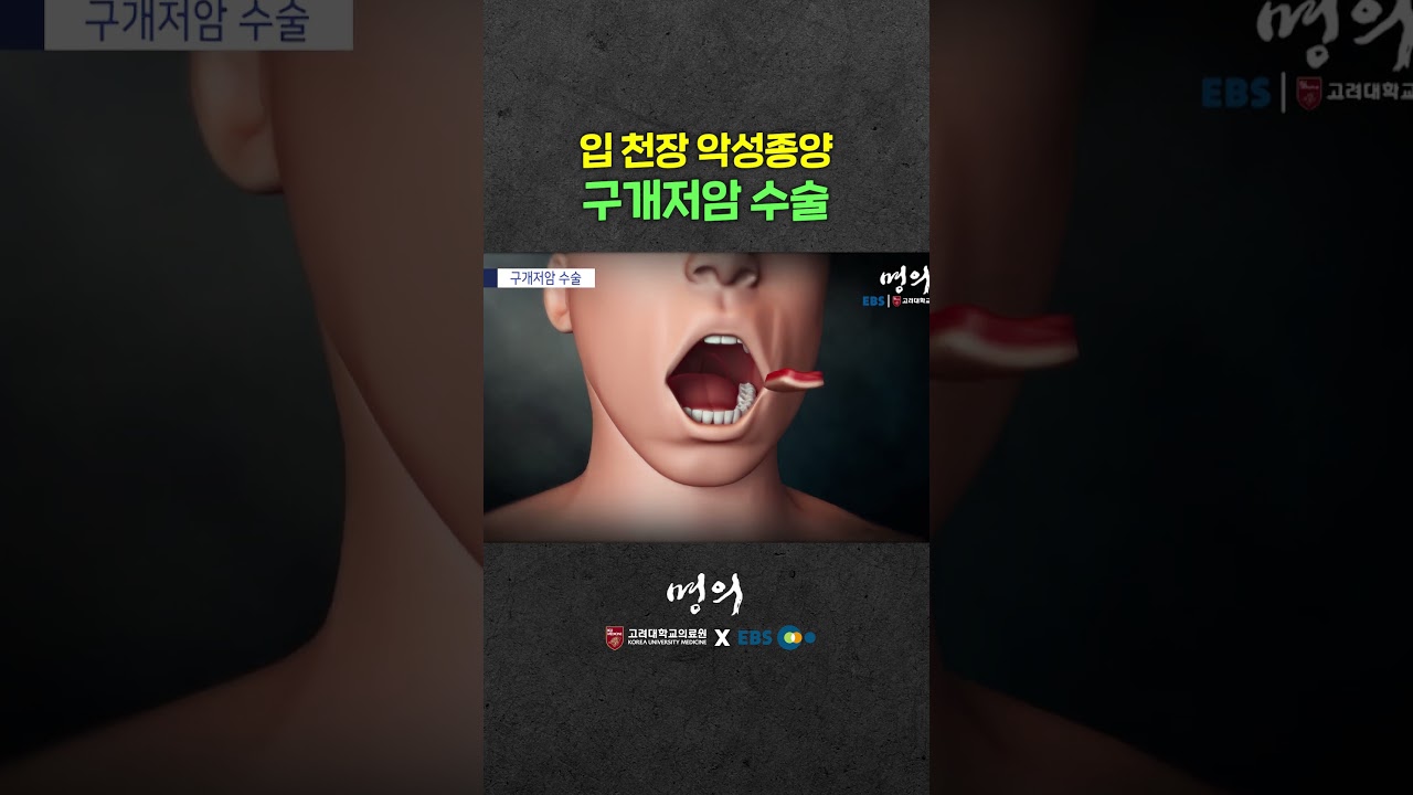 입천장에 생긴 종양, 어떻게 제거할까?