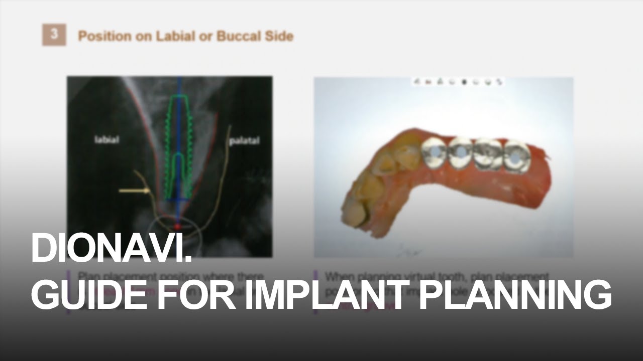 Implant Planning Guide _ Basic Concept