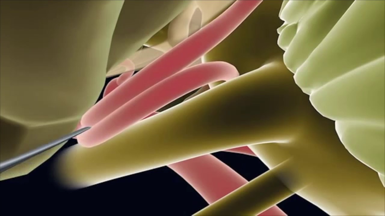 Endoscopic Microvascular Decompression - Minimally Invasive Brain Surgery