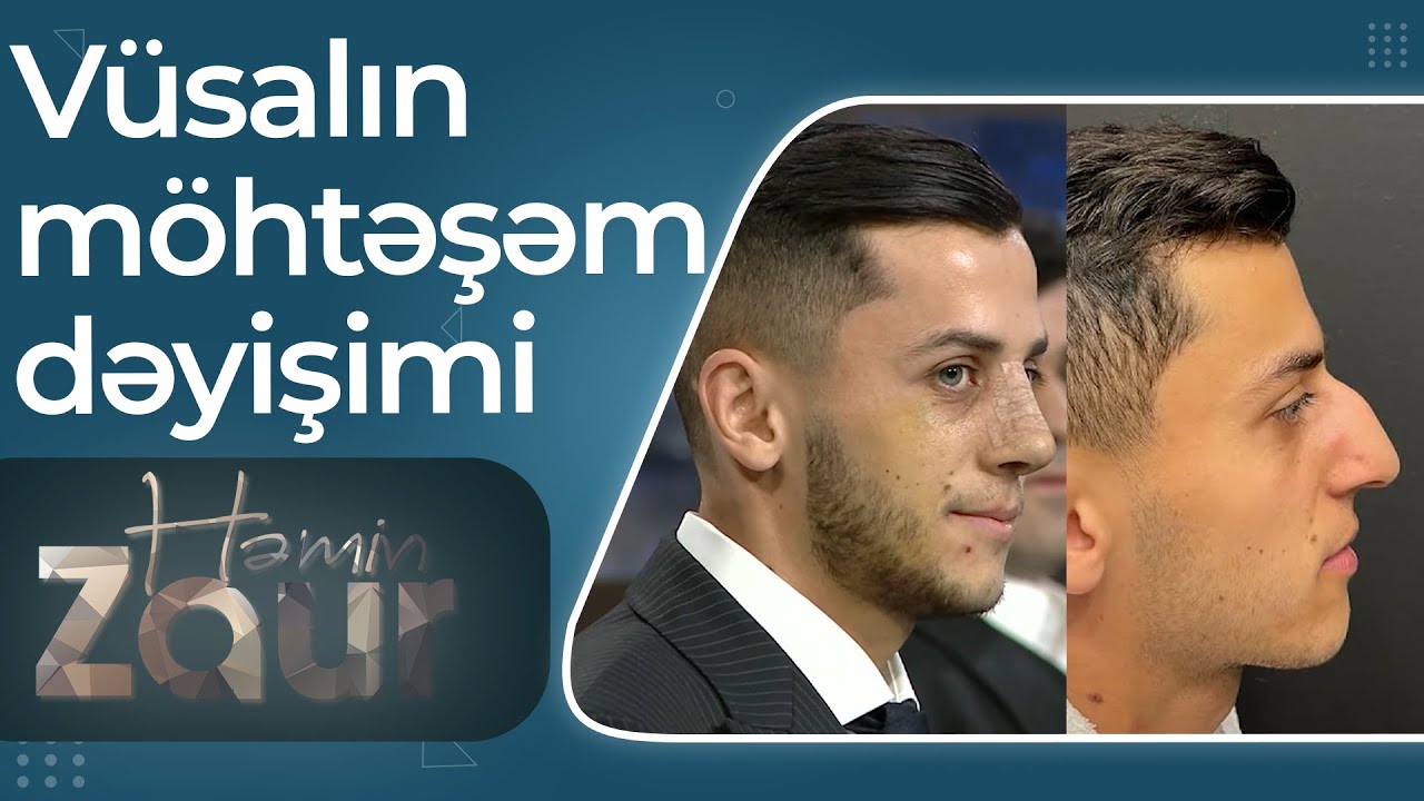Həmin Zaur - Topçu Vüsala burun əməliyyatı edildi