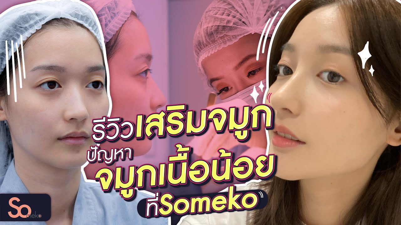 รีวิวจมูกเนื้อน้อยก็โด่งได้ เล่าละเอียดเสริมจมูกครั้งแรกกับหมอมิวsomeko