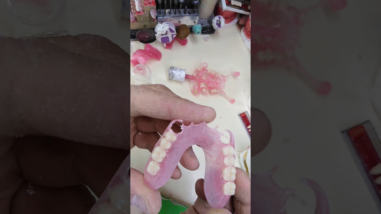 Prothèse flexible étape 1