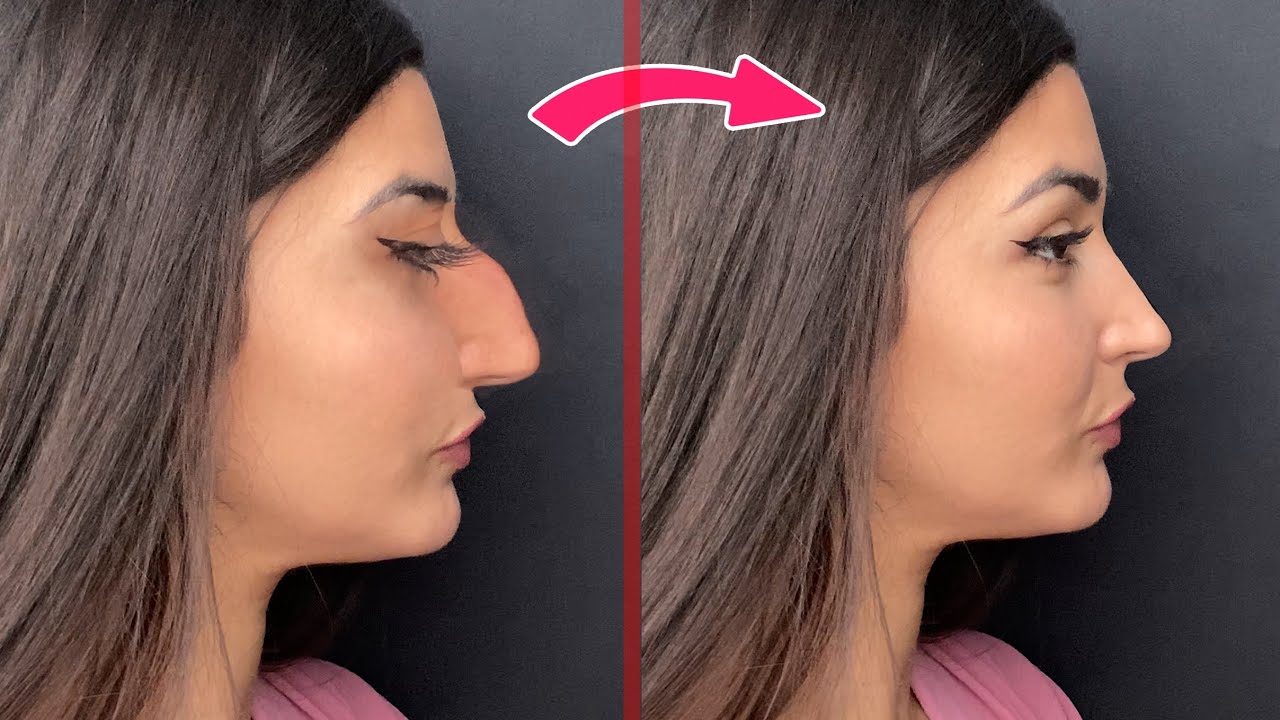 👃🏼 RINOPLASTIA CASERA 👃🏼 | La Pelo