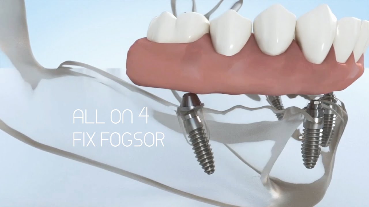 Fix fogsor implantátumokon és az All on 4 rendszer - Mit érdemes róla tudni?