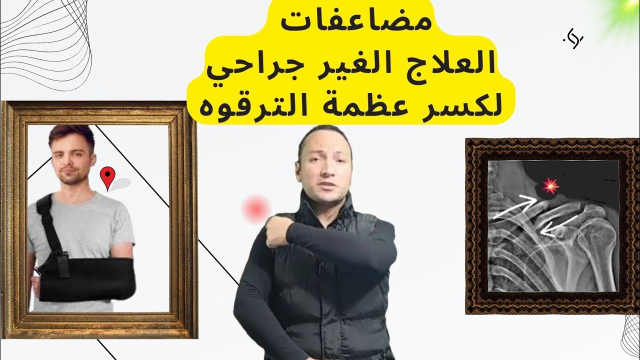 كسر عظمة الترقوه(مضاعفات العلاج الغير جراحي _ التحفظي ) fracture clavicle comp.